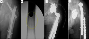 Complicaciones asociadas en el mismo paciente. A) Cut-out clavo «corto» Gamma3™. B) Fractura intraoperatoria periprotésica Vancouver B1 (círculo amarillo). C) Control postoperatorio: la lesión acetabular por tornillo precisó del uso de cuñas de tantalio para rellenar el defecto. Placa fémur distal por fractura intraoperatoria. D) Luxación protésica