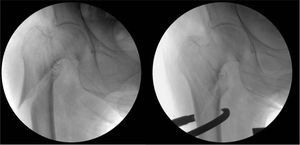 Uso de pinza colineal para la reducción de una fractura pertrocantérea de trazo invertido con lateralización del segmento proximal y deformidad en varo.