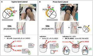 Patient fixed positioning for the Versatile Extended Anterolateral (EAL) Approach and main indications for each position (A. Supine semi-lateral. B. Prone semi-lateral). Schematic representations of a left tibial plateau in these positions and the access through each window (PF: pre-fibular; SF: supra-fibular; RF: retro-fibular; TF: trans-fibular) to the lateral (L) and posterolateral (PL) columns. In prone semi-lateral position, the EAL Approach can be combined simultaneously with the Modified Oblique Lobenhoffer (MOL) approach. Diagrams illustrate the relationship between the Main Deformity Direction (MDD), associated PL column deformities and the preferred fixed position to counteract the deformity vector. In complex multicolumnar (MC) PL-MDD fractures, the EAL Approach in prone semi-lateral position may facilitate control of the posterolateral deformity (green arrow). The EAL and MOL approaches can also be complementary for simultaneous management of the PL column in selected multicolumnar fractures.