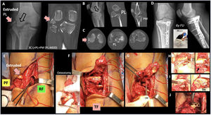 Clinical case example of a multicolumnar PL-MDD fracture managed using the trans-fibular window (EAL-TF). (A) AP/coronal view. Extruded posterolateral fragment (red arrow) embedded between the fibular head and the lateral femoral condyle. PL-MDD: posterolateral Main Deformity Direction (black arrows). (B) Lateral/sagittal view. Defect on the posterolateral (PL) column corresponding to the extruded fragment. (C) Axial CT. Extruded fragment (red arrow) and PL defect. (D) Follow-up radiographs and clinical image at 6 years postoperatively. (E) EAL approach in prone semi-lateral position. The embedded fragment (asterisk) could not be mobilized through the pre-fibular (PF) and retro-fibular (RF) windows. (F) Fibular neck osteotomy allowing mobilization of the trapped extruded fragment (asterisk) through the trans-fibular (TF) window. Expanded exposure of the lateral (L) and posterolateral (PL) columns. CPN: common peroneal nerve. Note the involvement of the tibiofibular joint in the fracture pattern. (G) Fracture exposure after mobilization of the extruded fragment (asterisk). Lateral meniscus (LM) identified within the fracture gap. (H) Reduction and fixation maneuvers. Clamp reduction and interfragmentary screw from posterior (PL column) to anterior (lateral column). Clamp reduction and interfragmentary K-wire fixation of the PL fragments (wire cut). (I) Tibiofibular joint (TFJ) reconstruction with trans-osseous sutures. (J) Lateral plate positioned in the posterior aspect of the lateral tibia. The lateral meniscus was reattached before fixation of the fibular osteotomy with a 3.5mm intramedullary screw.