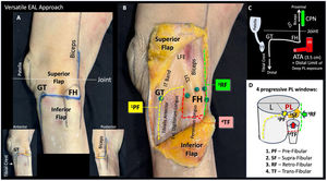 Versatile EAL Approach. (A) Landmarks and skin incision (blue line). GT: Gerdy