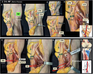 Third window: Retro-fibular (RF). A) Fascial incision just posterior to the biceps (green line). B) Identification of the Common Peroneal Nerve (CPN) and the Lateral Sural Cutaneous Nerve (LSCN) under the fascia. C) Distal progression of the fascial incision following the pathway of the CPN over the fibular neck. Identification of the lateral gastrocnemius (LG) under the CPN. D) Medial / posterior retraction of the LG and identification of the soleus (fibular origin) and the popliteus. At this point, the inferior lateral genicular artery (ILGA) can be present over the popliteus and ligated. Asterisk in the diagram: ILGA. Note that the workspace is between the CPN and LSCN. E) Anatomical detail of the popliteal neurovascular bundle location in the interval between the lateral gastrocnemius (LG) and the popliteus (not necessary for the surgical approach). The red vessel loop identifies the anterior tibial artery (ATA), located at 3.5 cm from the tip of the fibular head in this cadaveric specimen. PA: popliteal artery. PV: popliteal vein. TN: tibial nerve. CPN: common peroneal nerve. F) Interval between the popliteus (tibia) and soleus (fibula) (white dotted line). G) Exposure of the retro-fibular window (asterisk) retracting the popliteus superiorly. The ATA represents the distal limit for exposure through this window. Note that the skin incision is designed to facilitate maximal exposure of this window. H) Reference of the deep retro-fibular interval (dotted line) in an anatomic model, and diagram of the RF window (asterisk) limited distally by the ATA.