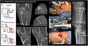 Technique concept: straight posterolateral buttress plate through the retro-fibular (RF) window. (A) Diagram representing PL reduction in PL column split fracture with the apex located distally to the level of the fibular head. From the RF window distal reduction of the apex may be feasible. (B) Diagram represents the relation between the posterior buttress plates and the anterior tibial artery (ATA) in AP view, and the buttress effect in lateral view (green arrows), using a short plate or a longer plate beneath the ATA. (C) Clinical case example of a two-column (2C) lateral (L)+posterolateral (PL) fracture. PL column split fracture with the apex located distal to the fibular head level, where posterior buttress plate fixation was considered preferable. Note that in this case a horizontal supra-fibular (rim or belt) plate could displace the PL apex distally, not being appropriate for biomechanical control of the split PL fracture. (D) Clinical image of the pre-fibular (PF) window. Through the PF window: reduction and fixation of the lateral column (split-depression fracture), and reduction of the articular part of the PL column (split fracture). (E) Clinical image of the supine semi-lateral fixed position and the retro-fibular (RF) window (yellow arrow). Through the RF window: reduction of the distal apex of the PL split fracture using a posterior buttress plate. Screwdriver is marking the direction of the distal screw. The ATA was present just distally. (F) Postoperative radiology. Note that the screw fixation of the posterior plate is limited distally by the ATA, however it is possible to use a longer plate, to increase the buttress effect (green arrow), carefully sliding subperiosteally the plate beneath the ATA like in this case example. White arrow: inferior obliquity direction of the most distal screw, cranial to the ATA location.