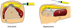 HA injection technique for the plantar fascia. 1: Plantar fat pad; 2: Abductor hallucis muscle; 3: Calcaneus; 4: Abductor digiti minimi pedis; A: Medial band of the plantar fascia; B: Lateral band of the plantar fascia.