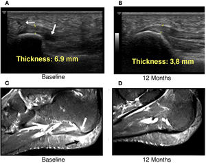 Example of changes in the plantar fascia (patient number 3) before the injection and 12 months later (ultrasound images [A and B] and nuclear magnetic resonance images [C and D]).