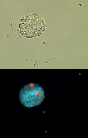 Fluorescence and bright field microscopy images. A macrophage can be seen along with several abnormal sperm in bright field (A). Fluorescence microscopy shows, in the same field, how several of these sperm cells are undergoing necrosis; moreover, several sperm cells (red color) have been phagocitized by the macrophage (B). (For interpretation of the references to color in this figure legend, the reader is referred to the web version of this article.)