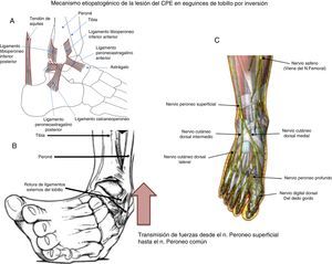 Mecanismo etiopatogénico de la lesión del nervio peroneo común tras un esguince por inversión del tobillo (Fuente: Nobel8). A: ligamentos externos del tobillo. B: mecanismo lesional de esguince de tobillo por inversión. C: inervación del tobillo y del pie.