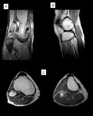 Resonancia magnética de la rodilla derecha en la que no se encuentran lesiones a nivel de la cabeza y cuello del peroné. A: corte coronal potenciado en T2. B: corte sagital potenciado en T1. C: corte axial potenciado en T1.
