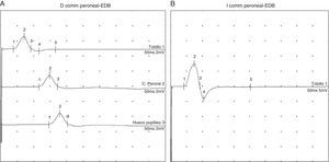 Electromiografía comparativa del nervio peroneo común derecho (A) e izquierdo (B) en la que se observa la afectación del nervio peroneo común derecho.