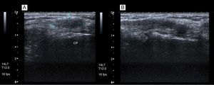 Ecografía de rodilla derecha. A: plano axial: se aprecia una imagen hipecoica y engrosamiento del nervio peroneo común adyacente a la cabeza del peroné (CP). B: dicha imagen se aprecia igualmente en el plano longitudinal.