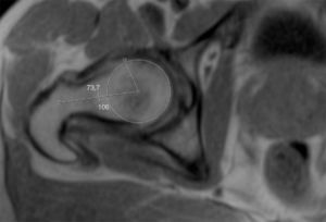 Resonancia nuclear magnética: medición de ángulo α.: 73°. Cambio quísticos en la unión cervicocefálica llamados fositas del cuello femoral. Islote óseo en cabeza femoral.