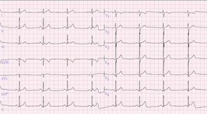 Electrocardiograma basal. Ritmo sinusal a 55 latidos por minuto; eje QRS a 60°; intervalo PR de 150ms; intervalo QRS de 80ms; intervalo QT de 394ms e intervalo QTc de 366ms.
