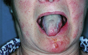 Vesículas transparentes sobre base eritematosa + lengua saburral con triángulo rojo en la punta de la lengua2.