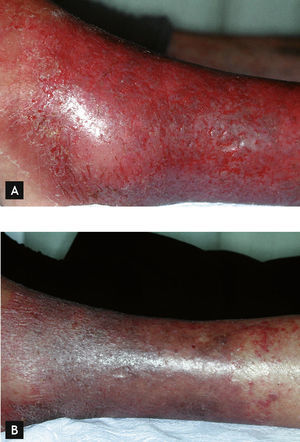 A: periflebitis aguda. B: resultado a los 5 días de tratamiento con Vipera 5 CH.