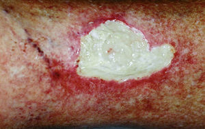 Úlcera en sacabocados con secreción verdosa.