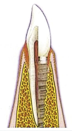 Gingivitis y mucositis.