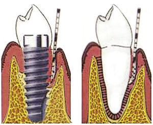 Periodontitis y periimplantitis.