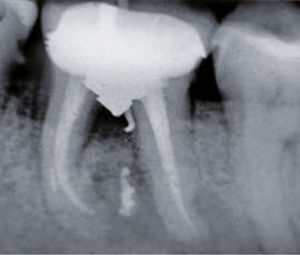 Caso 1. En la radiografía se observa el defecto óseo entre las 2 raíces (bifurcación) y un cuerpo extraño.