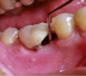 Caso 1. La sonda penetra 6 mm en la bolsa anterior (mesial). Foto hecha con un espejo bucal 1 mes después de la cirugía.