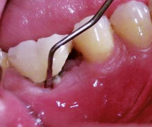 Caso 1. La sonda penetra 8 mm entre la bifurcación de las raíces. Foto hecha con un espejo bucal 1 mes después de la cirugía.