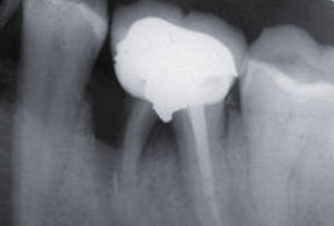 Caso 1. Aspecto de la muela una vez eliminado el trozo de raíz partido y el cuerpo extraño. Presenta un defecto óseo importante desde la raíz distal al premolar (3 meses después de la cirugía).