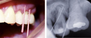 Caso 2. Presenta 2 abscesos periodontales fistulizados, las 2 puntas de gutapercha penetran por el recorrido de la fístula, como se observa en la radiografía, terminando una en mesial del primer molar y la otra en distal del segundo premolar.