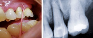 Caso 2. La fístula del molar ha desaparecido a los 20 días de iniciar el tratamiento, persistiendo la fístula del premolar.