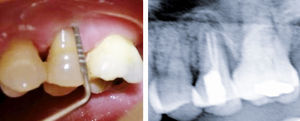 Caso 2. Aunque persiste la bolsa periodontal, per-manece asintomática.