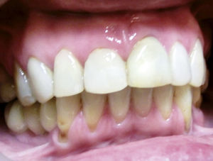 Caso 3. A los 3 años sigue asintomática y con el diente partido.