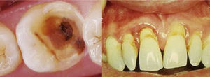 Caries y enfermedad periodontal.