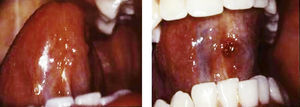 Extirpación de una glándula salival hipertrofiada.