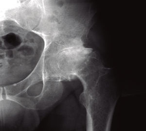Radiografía de 2009: caso necrosis aséptica.