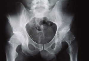 Radiografía de 2002: caso necrosis aséptica.