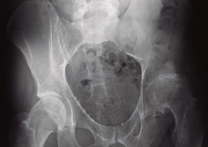 Radiografía de 2006: caso necrosis aséptica.