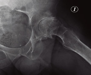 Radiografía (abducción) de 2007: caso necrosis aséptica.