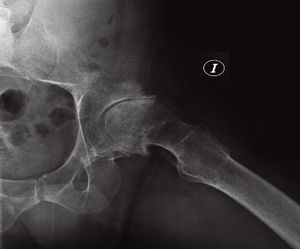 Radiografía (abducción axial) de 2008: caso necrosis aséptica.