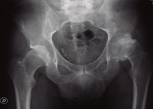 Radiografía (anteroposterior) de 2009: caso necrosis aséptica.
