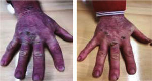 Fotografías de las manos tras 3 días de tratamiento.