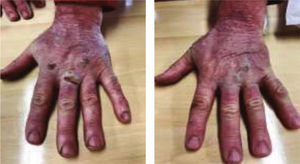 Fotografías de las manos tras 8 días de tratamiento.