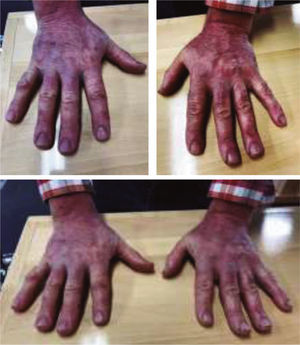 Fotografías de las manos tras 17 días de tratamiento.