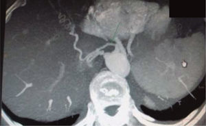 Angiografía por tomografía computarizada: origen sistémico del aporte arterial al lóbulo medio, proveniente del tronco celíaco, sugerente de malformación pulmonar congénita del tipo secuestro pulmonar.