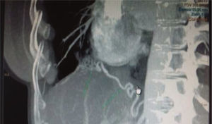 Angiografía por tomografía computarizada: origen sistémico del aporte arterial al lóbulo medio, proveniente del tronco celíaco, sugerente de malformación pulmonar congénita del tipo secuestro pulmonar.