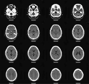 RM en la que destaca la presencia de atrofia cerebral leve de predominio frontal.