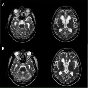 Evolución de RMN cerebral. Pie de imagen: RMN cerebral en secuencia T2, cortes transversales a nivel de protuberancia (A1 y B1) y ganglios de la base (A2 y B2), de nuestro paciente. Las imágenes A) corresponden a la RMN realizada durante el ingreso, a los 24 días del inicio de la clínica, y las imágenes B) a la realizada a los 8 meses. En ambas se objetiva una hidrocefalia triventricular sin que se evidencien las lesiones desmielinizantes características de la mielinólisis osmótica ni en protuberancia ni en ganglios de la base.