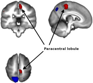 Increased activation in the paracentral lobule.