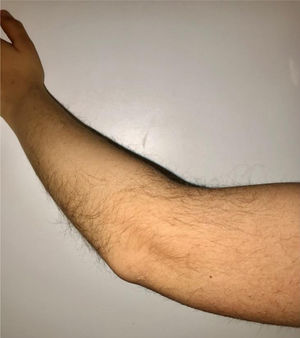 Hypertrichosis in the upper dorsal elbow area.