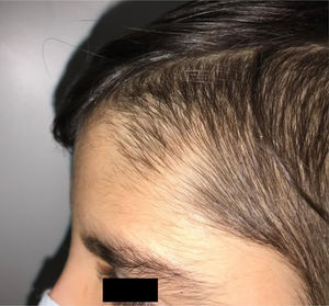 Outside eyebrow and frontal hair.
