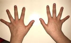 Widened and thickened hands and fingers.