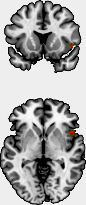 Positive correlation between grey matter volume/cortical thickness and insight in right insula.
