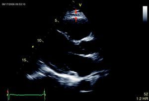 Medición ecocardiográfica del espesor de la grasa epicárdica. La grasa epicárdica se identifica como el espacio (entre flechas rojas) entre la pared externa del miocardio y la capa visceral del pericardio en un eje paraesternal largo.
